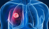 Google akciğer kanserini yapay zeka ile teşhis edecek